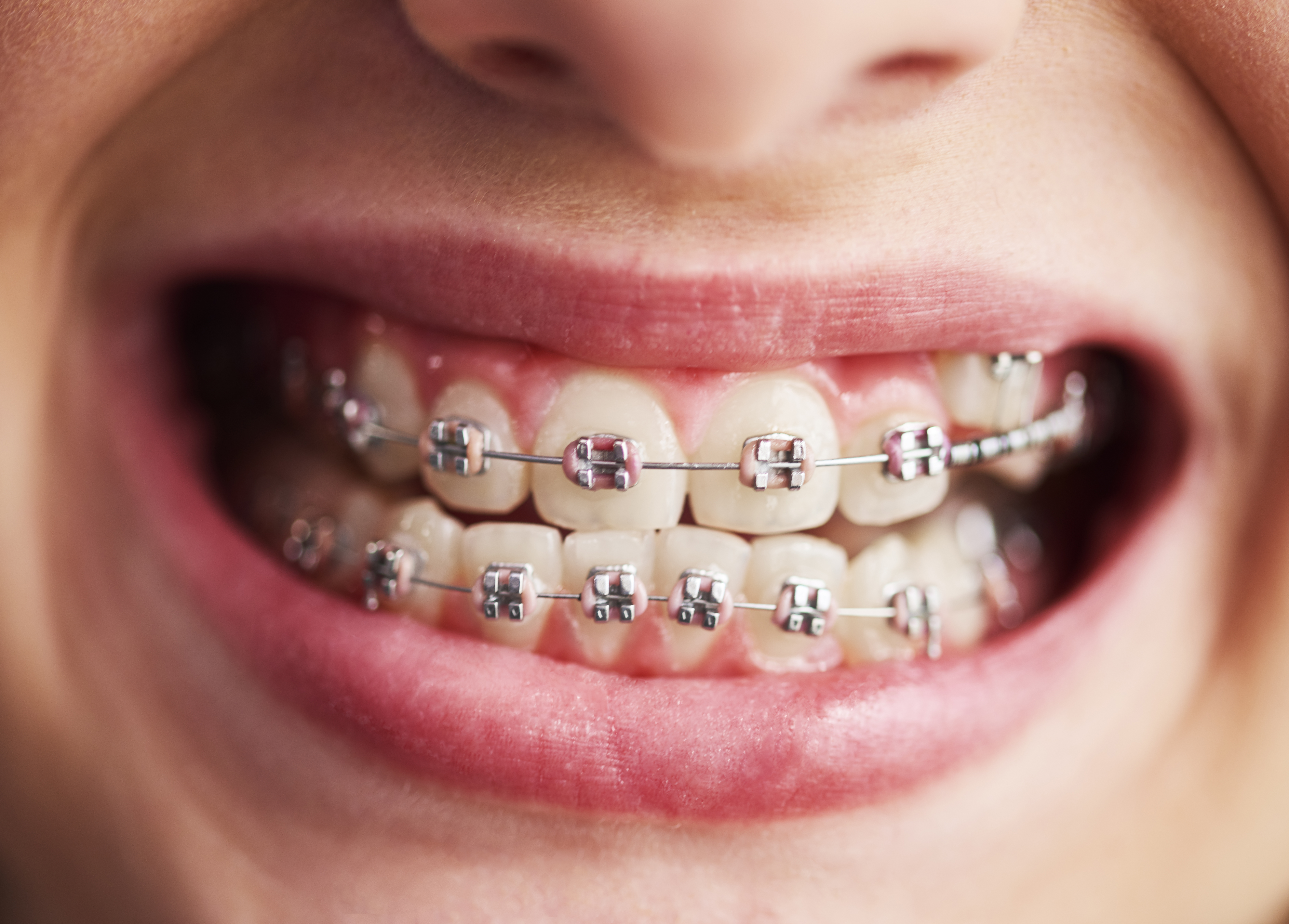 Braces & Aligners