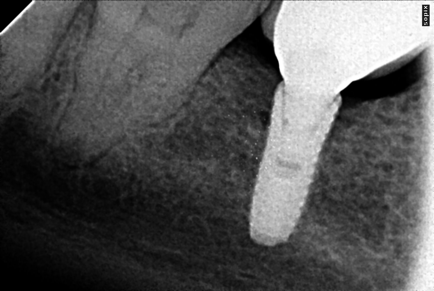 Implants